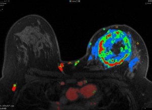 Diamonds could help spot early stage cancers